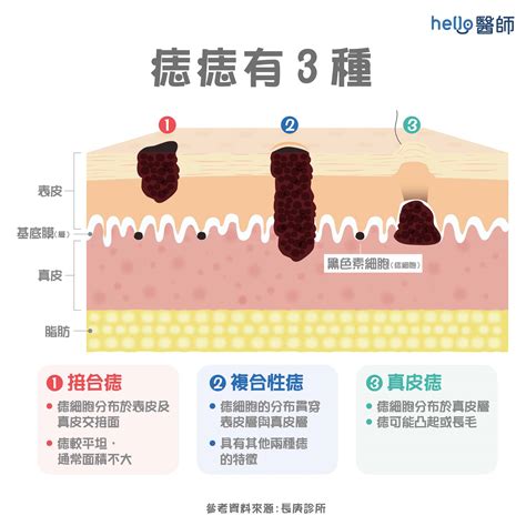 長痣原因|痣變大、痣多或長毛會變皮膚癌？認識痣的形成與原因